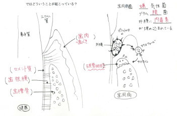 歯周病　図解