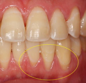 下がった（痩せた）歯ぐき