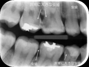 自覚症状のない虫歯　歯と歯の間に大きな虫歯があります