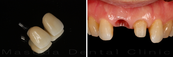 インプラントに冠をかぶせる前の状態とセラミック冠