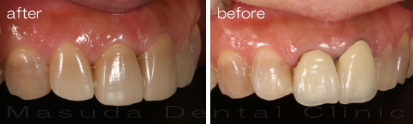 自然な見た目を回復するセラミック冠治療