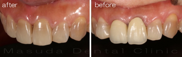 セラミック冠　きれいで自然な歯