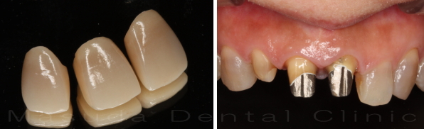 セラミック冠治療途中