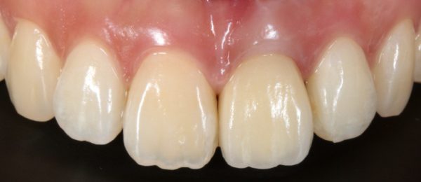 前歯へのインプラント治療