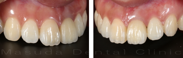 前歯へのインプラント治療　治療後 大阪豊中市ますだ歯科医院