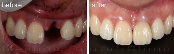 インプラント　前歯　怪我　大阪豊中の歯医者
