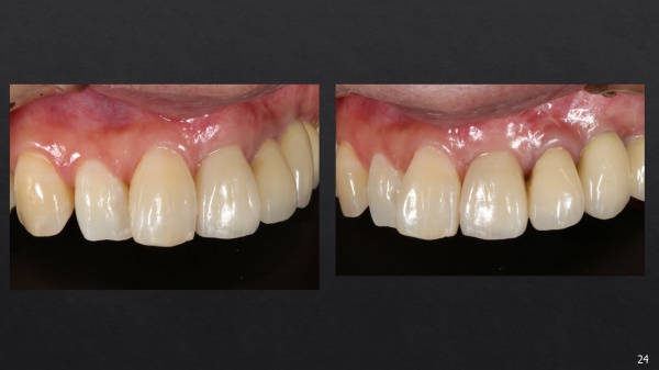 インプラント治療後　前歯