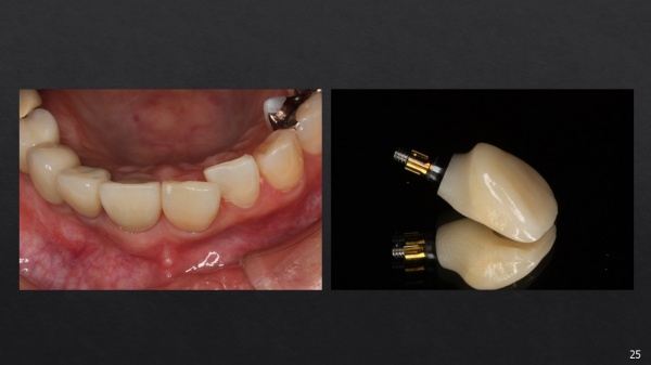 インプラント治療後２