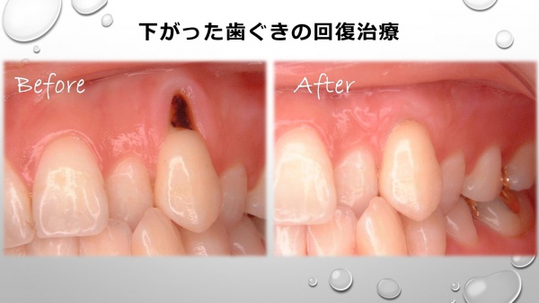 歯ぐき下がりの治療前後　実際の治療例