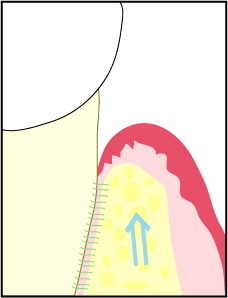 再生療法イラスト４