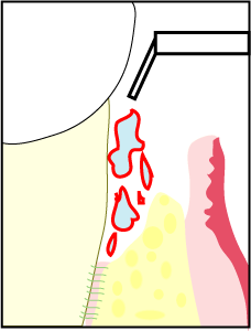 再生療法イラスト３