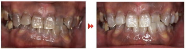 テトラサイクリン変色歯へのホワイトニング効果